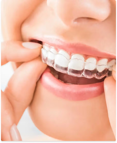 An Invisalign clear aligner