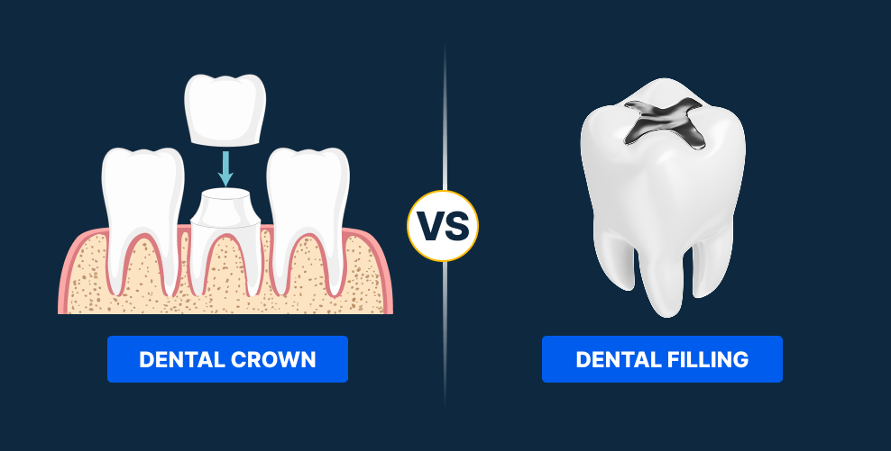 Dental Crown vs. Filling: Which One Do You Need?