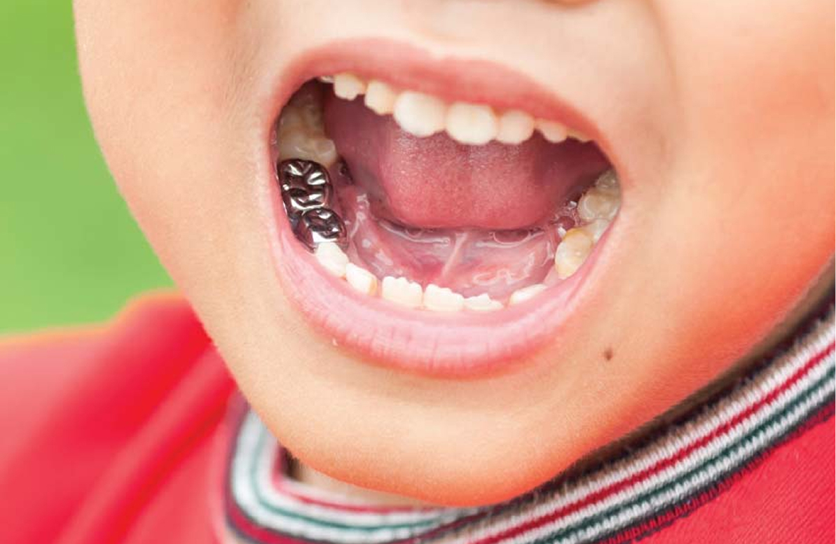 What Are the Silver Caps on Kids' Teeth?