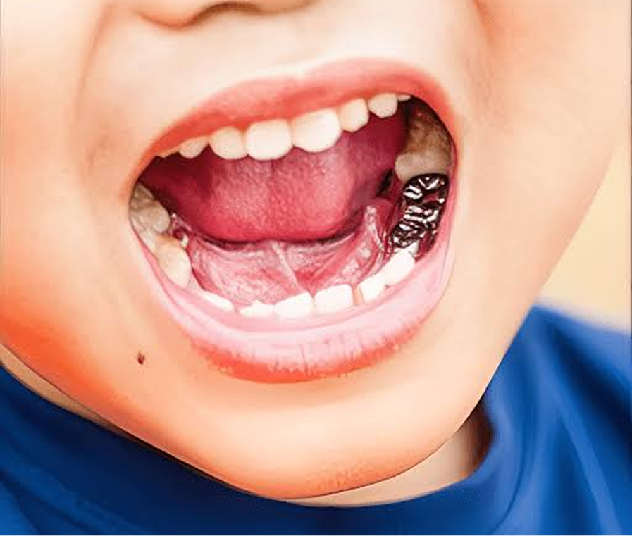 Catching cavities early at a routine checkup