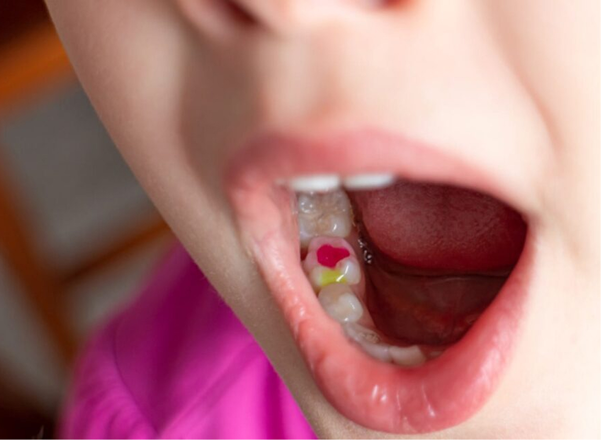 Tooth-colored composite fillings at Kennedy Dental Care