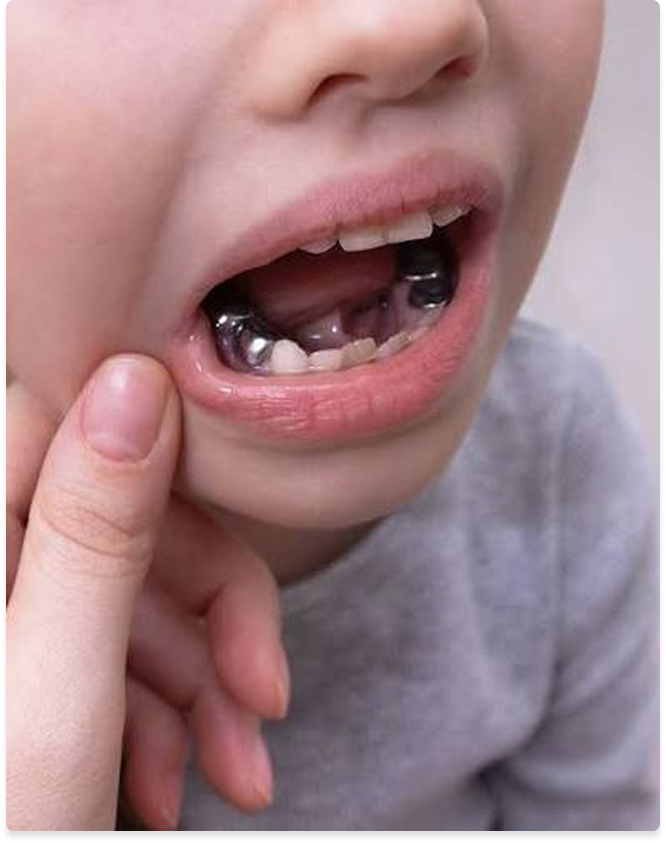 Dental crowns at Kennedy Dental Care