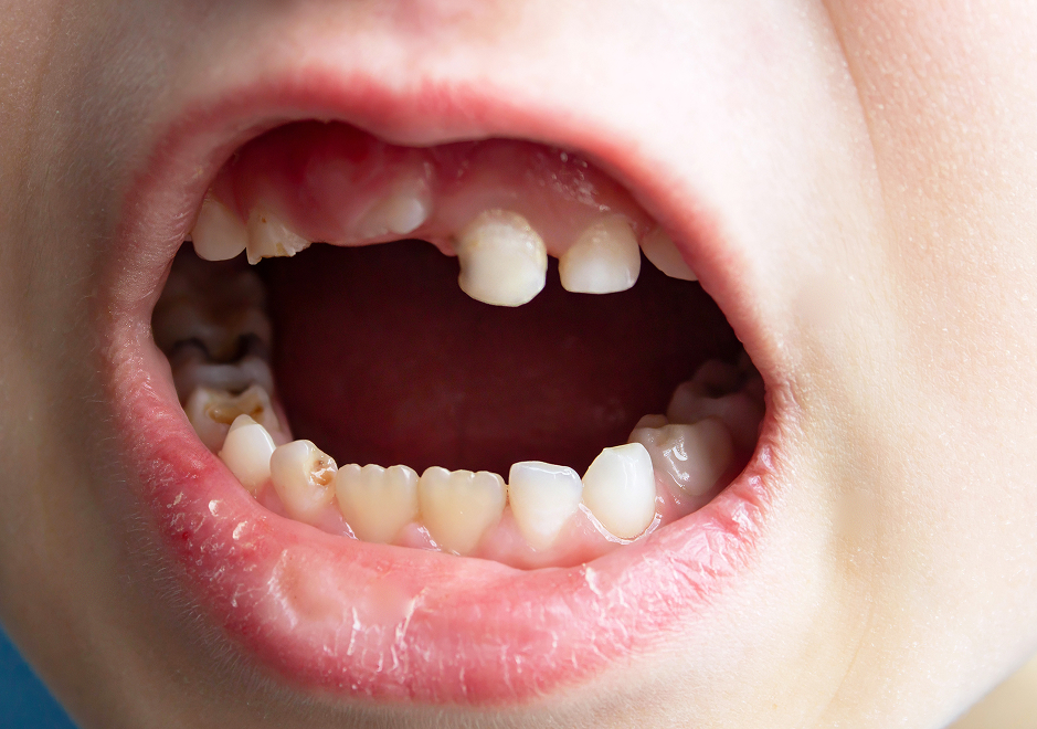 Does a Baby Tooth Cavity Need a Filling?