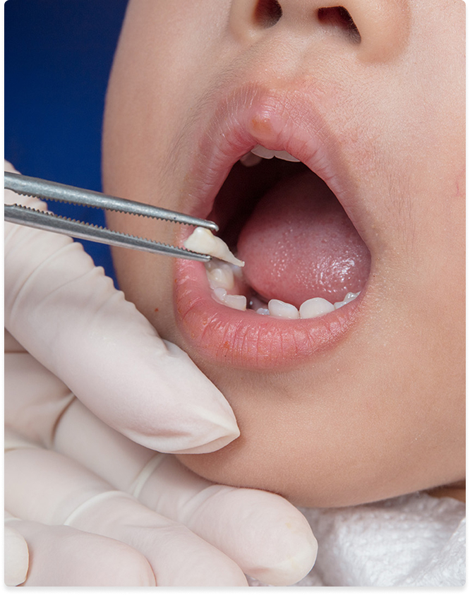 Tooth extractions at Kennedy Dental Care