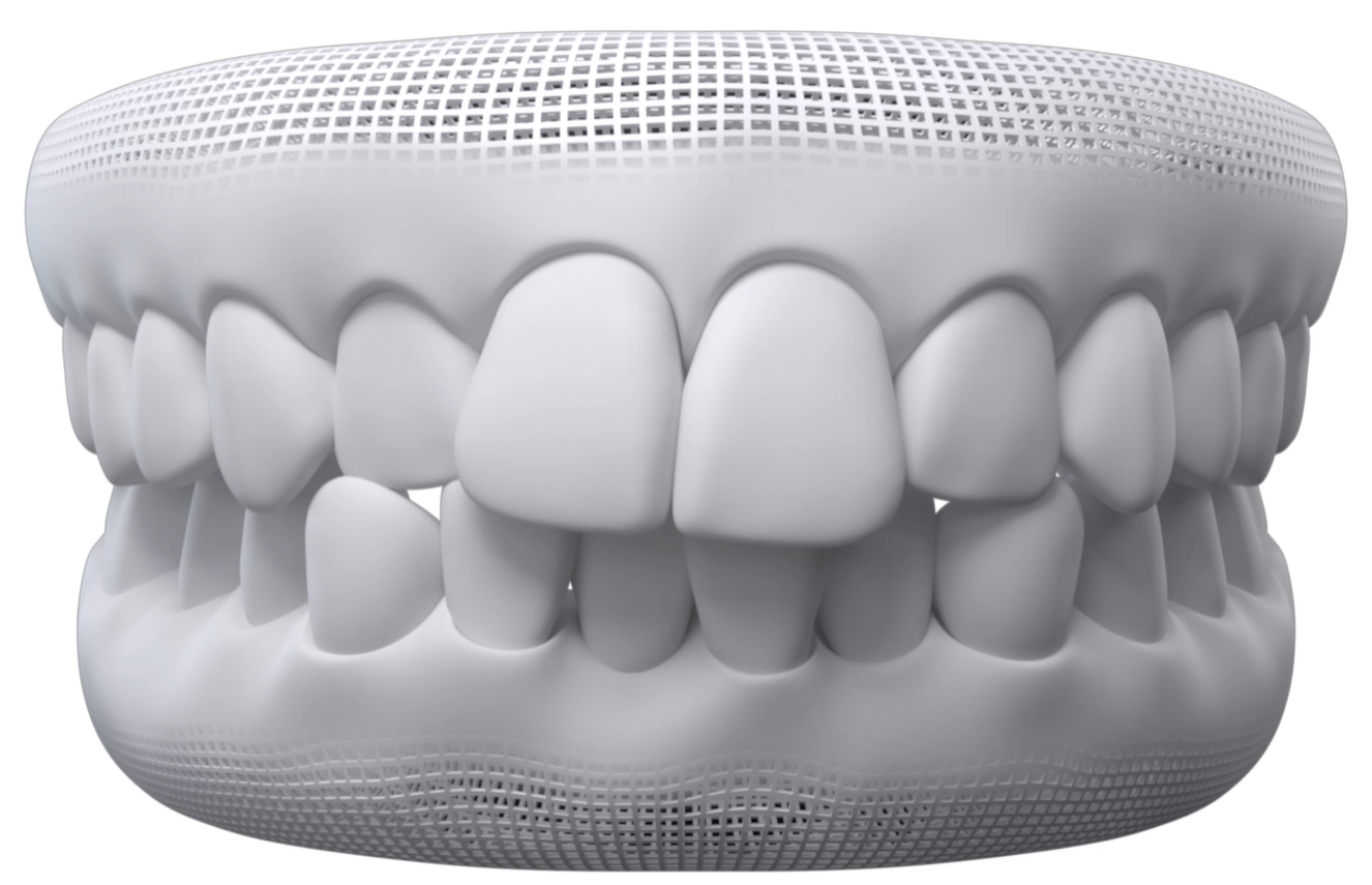 Dental model showing crowded teeth