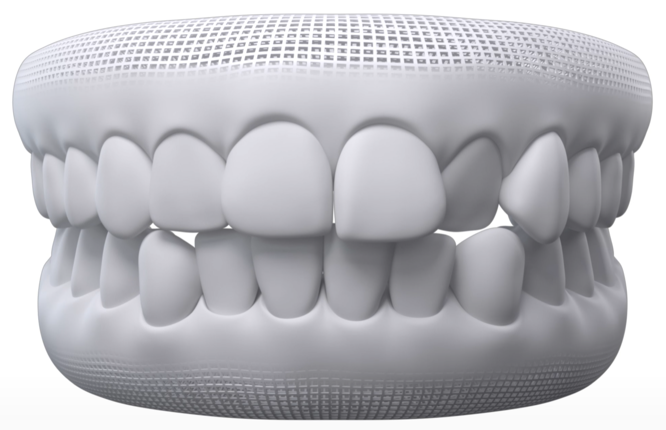 Dental model showing straighter teeth