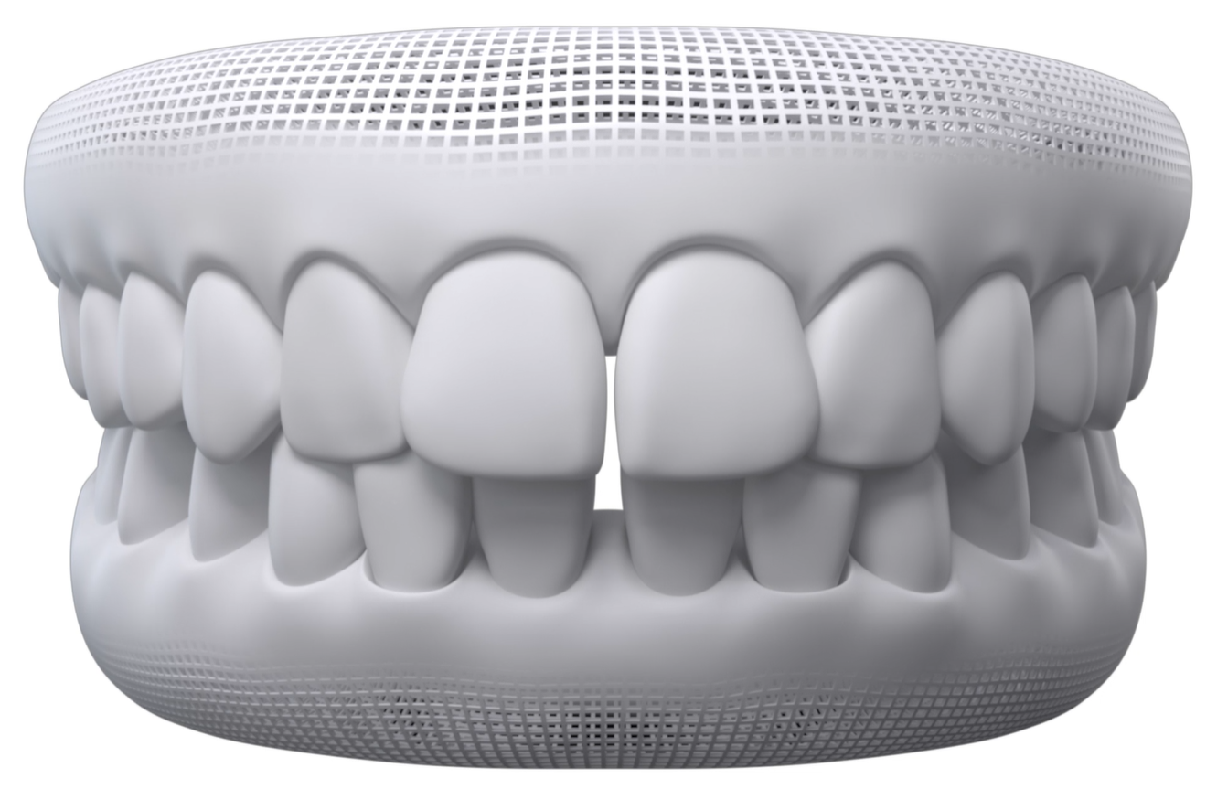 Dental model showing an overbite