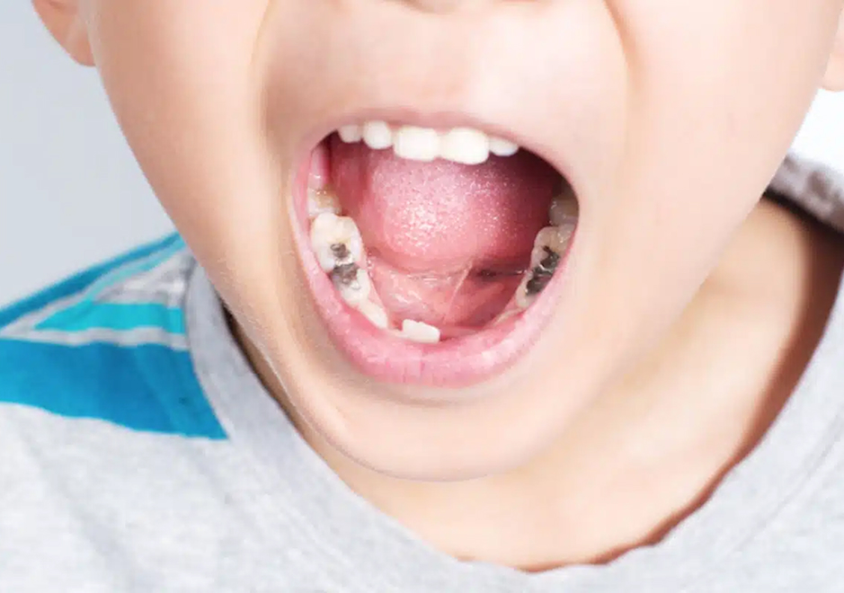 How to Prevent Cavities in Kids