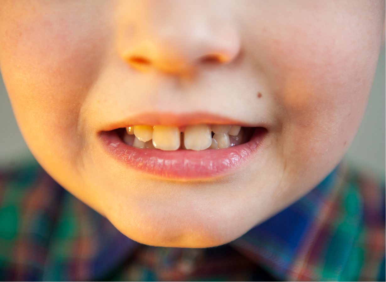 Frenectomy and front-teeth gap evaluation at Kennedy Dental Care