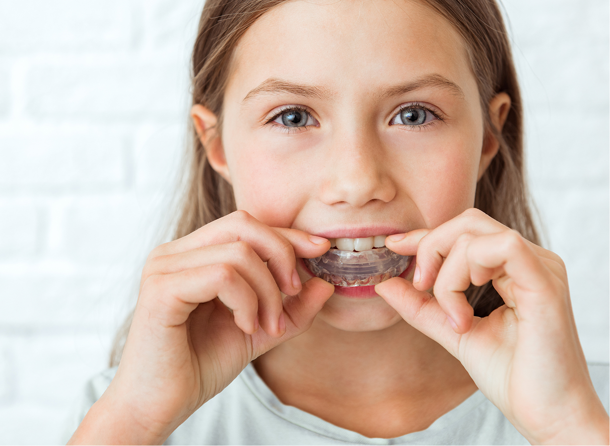 Custom-fitted sports mouthguard